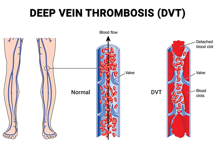 What Causes Legs To Ache All The Time Physical Therapists NYC