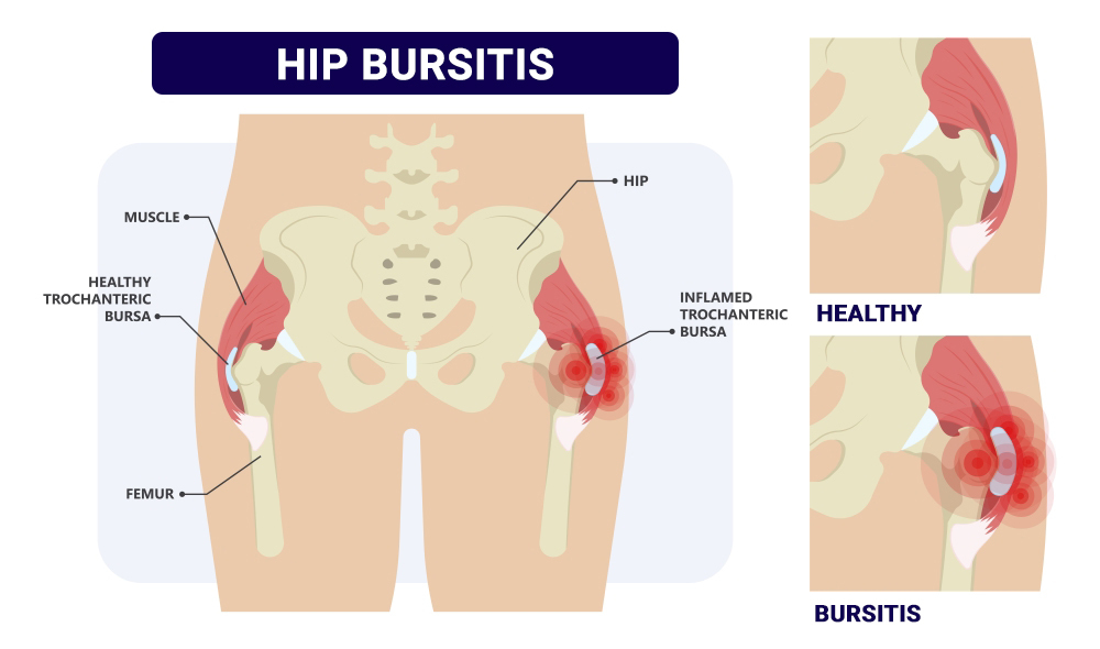 Hip Pain: Burswood Health, Chiropractic, Occupational Therapy