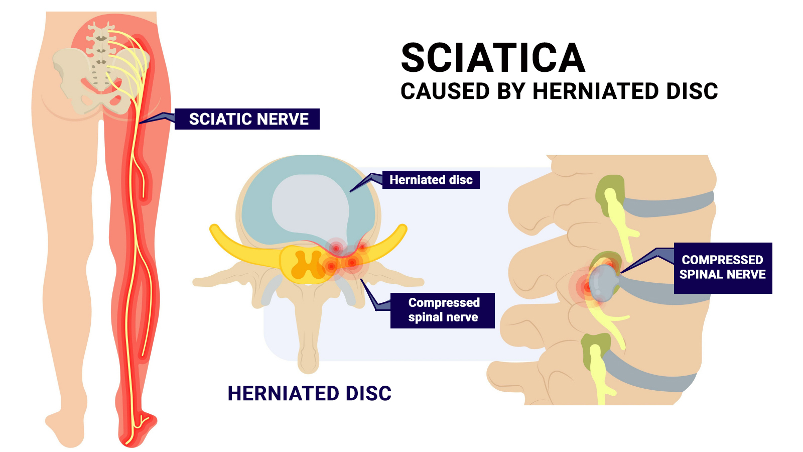 Therapia - Physiotherapy for Sciatica