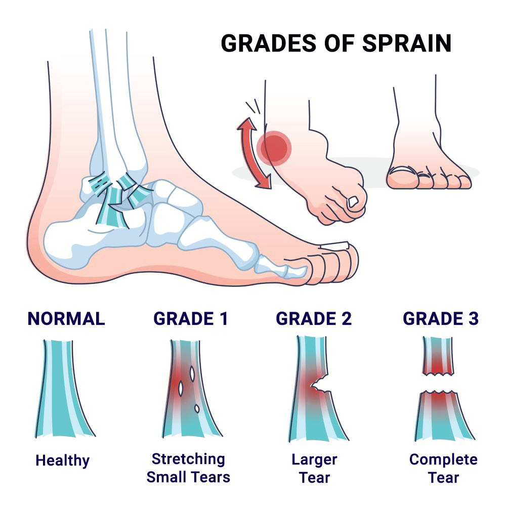 Sprained ankle treatment