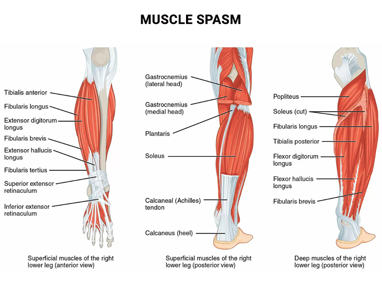 Muscle Spasm Muscle Cramps Treatment Physical Therapists NYC